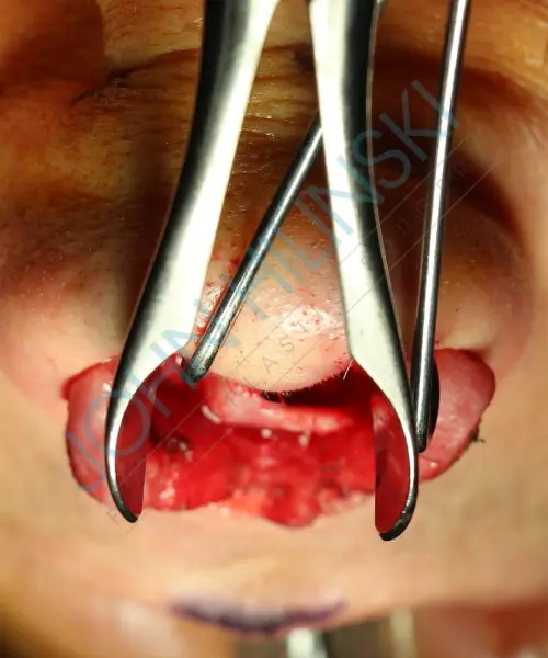 Surgical procedure on a nose, with clamps holding nostrils open and tissue exposed.