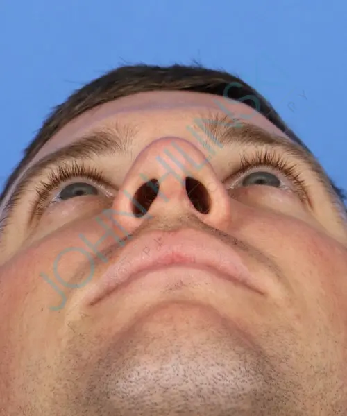 Close-up view of a person's face from below, focusing on the nose and chin against a blue background.