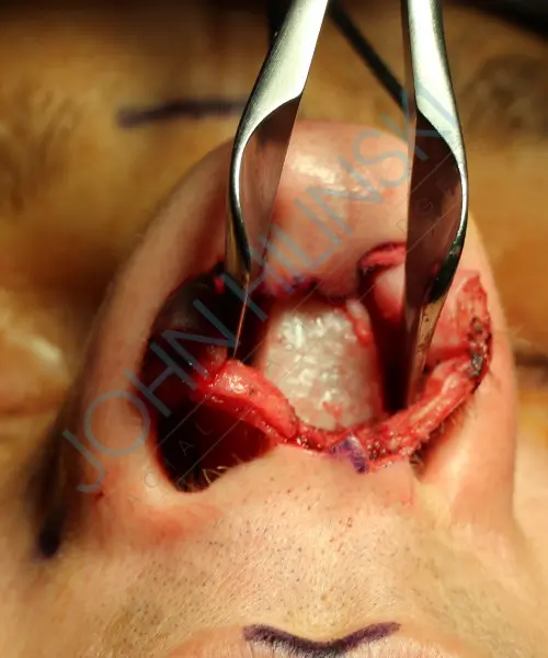 Surgical procedure on the nasal area with clamps holding open an incision, exposing tissue and bone.