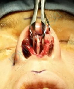 Close-up of nasal surgery in progress, showing surgical tools and open nasal tissue.