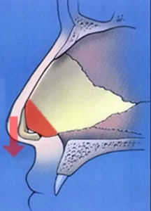 Illustration of a sagittal view of a human nasal cavity with a colored area highlighted and an arrow pointing downward.