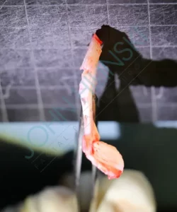A close-up of a surgical piece of tissue held by forceps against a gridded background.