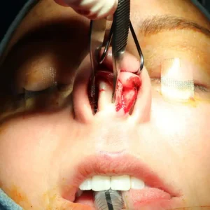 A close-up view of a surgical procedure on a person's nose, showing the nose opened with surgical instruments in use.