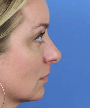 Profile view of a person's face against a blue background, showing a side view of the nose and eye.
