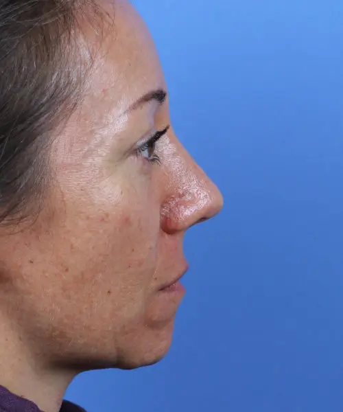 Profile view of a person's face against a blue background.