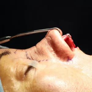 Close-up of a surgical procedure on a person's nose, showing surgical tools and incisions, with dotted guidelines on the skin.