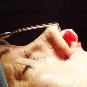 Close-up of a surgical procedure on a person's nose. A medical tool is visible, and the person's eyes are closed with bandages nearby.