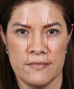 Close-up of a woman's face with red lines vertically highlighting the forehead, nose, and lips.