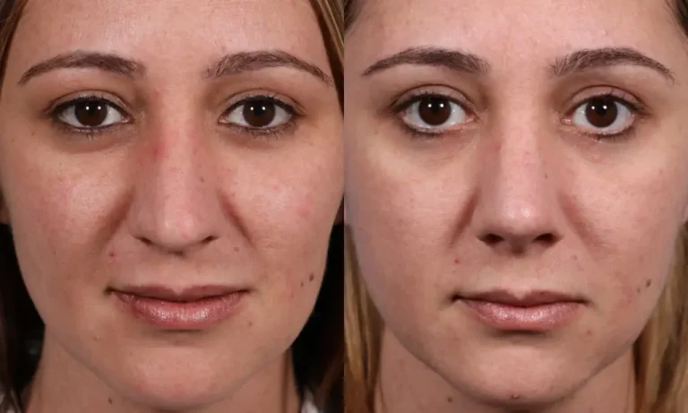 Side-by-side comparison of a woman's face before and after treatment, showing changes in skin tone and texture.
