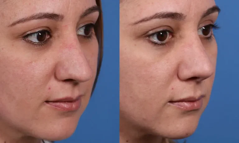 Side-by-side comparison of a woman's face before and after a skincare treatment, showing improvement in skin texture and tone against a blue background.