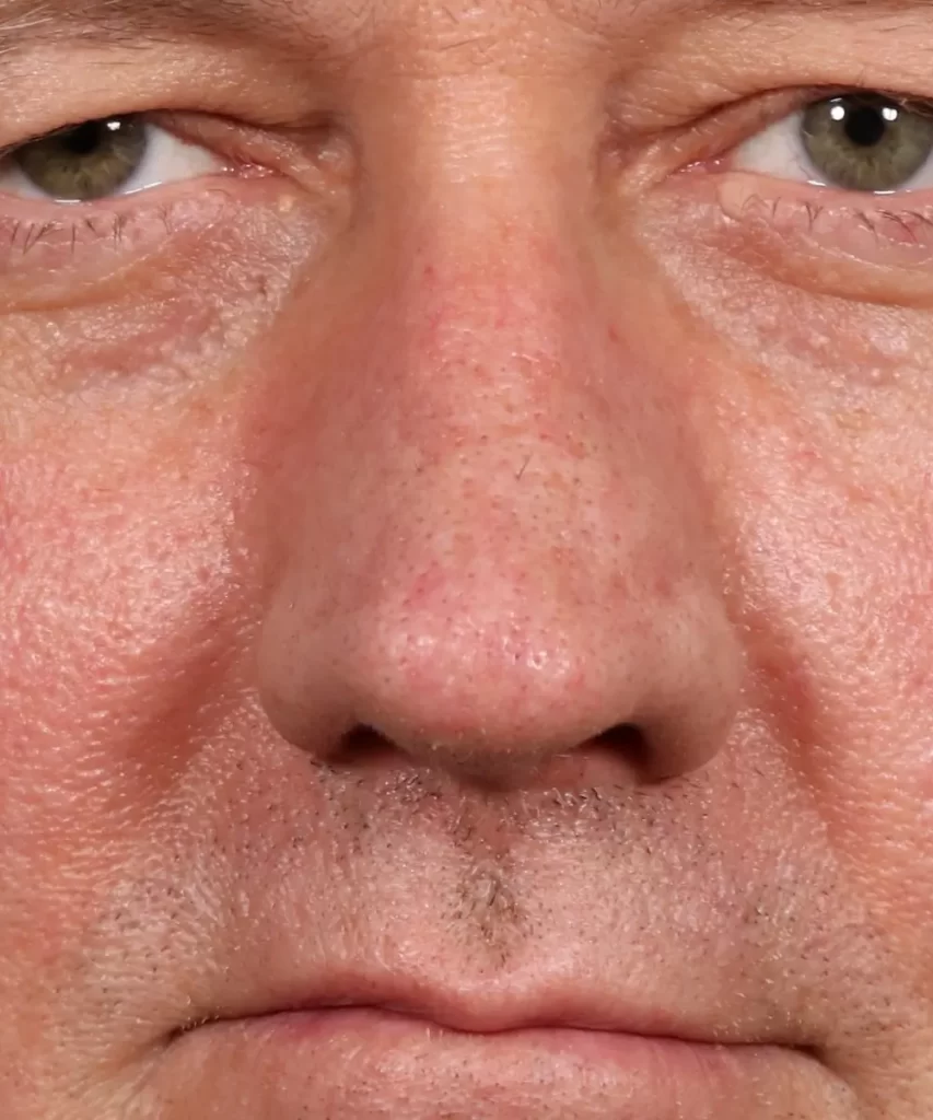 Close-up of a person's face showing detailed skin texture, eyes, and nose.