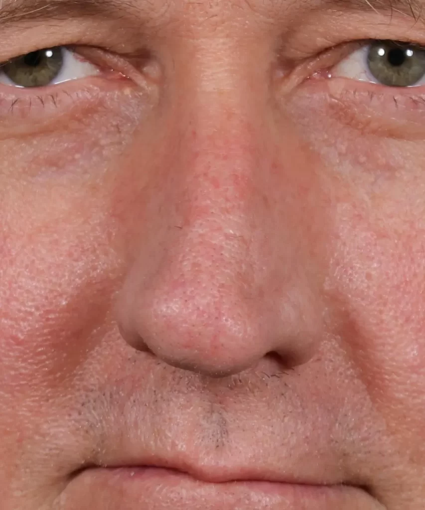 Close-up of a middle-aged person's face showing eyes and nose.