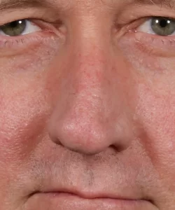 Close-up of a middle-aged man's face showing eyes, nose, and partial mouth, with visible skin texture and light facial hair.