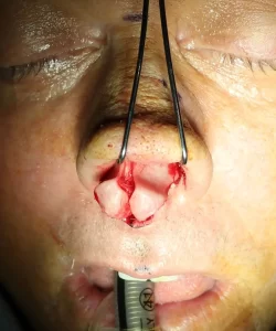 Close-up of a person's nose during surgery, with medical tools inserted in the nostrils.