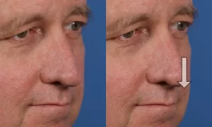 Side-by-side images of a man's face showing a downward arrow pointing to the nose in the second image, indicating change or focus.