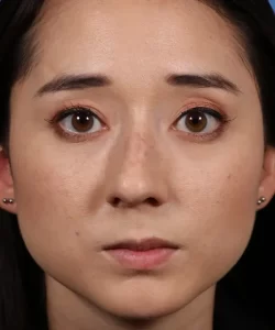 Front view of the face of a female patient with crooked nose