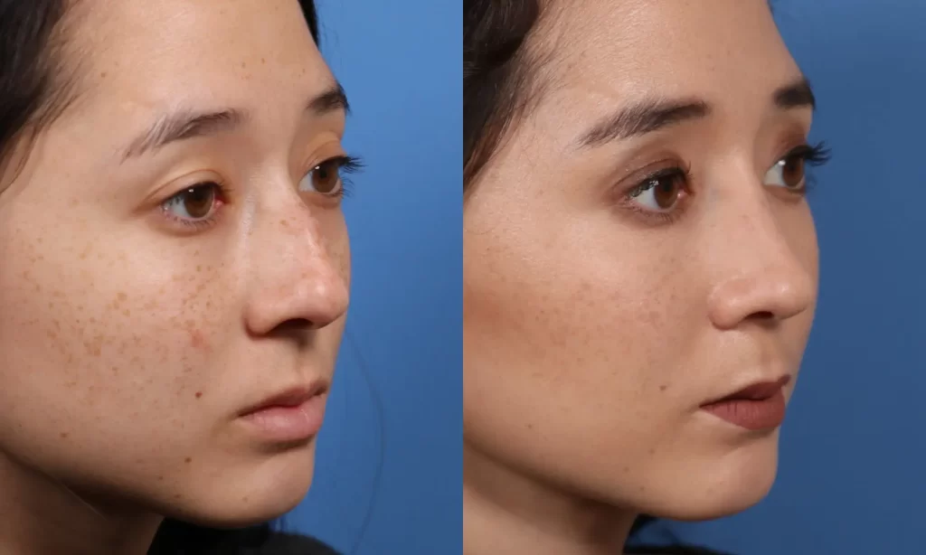 Oblique view of the face of a female patient before and after Scarless Rhinoplasty