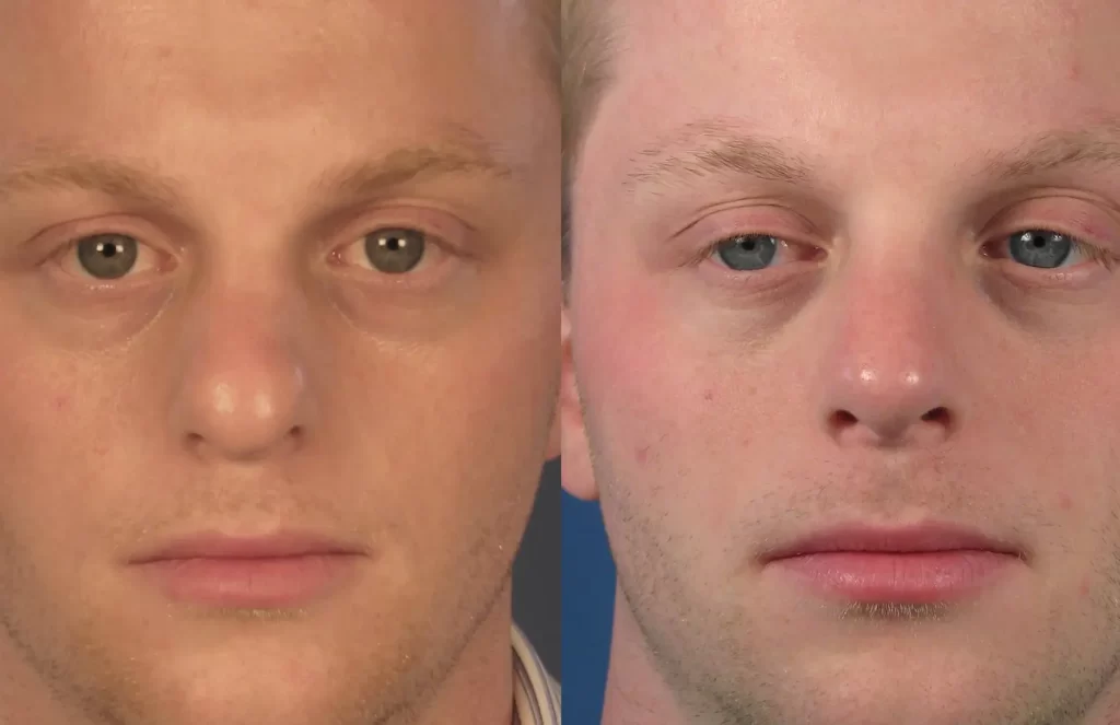 Side-by-side comparison of a man's face showing noticeable difference in skin tone and eye appearance between two images.