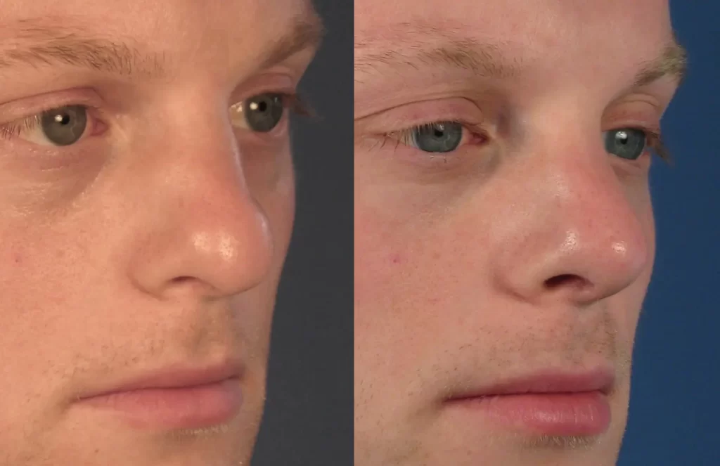 Close-up comparison of a man's nose before and after rhinoplasty. The left image shows a bulbous tip, and the right image shows a refined tip with a straighter profile.