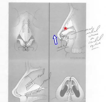 Surgical diagram showing nasal anatomy with annotations. Upper left: frontal view. Upper right: lateral view with blue arrow and red star. Lower images: additional nasal views with labeled structures.