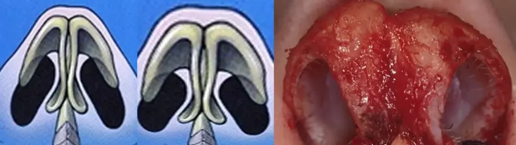 Comparison of a diagram illustrating nasal polyps and an image showing nasal polyps after removal.