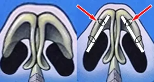 Diagram showing nasal airways: Left side depicts narrow airways; right side shows improved airflow with inserted rods, indicated by red arrows.