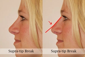 Side-by-side profiles of a woman's face before and after a cosmetic procedure, highlighting the change in the nasal bridge curve with a red line on the right.