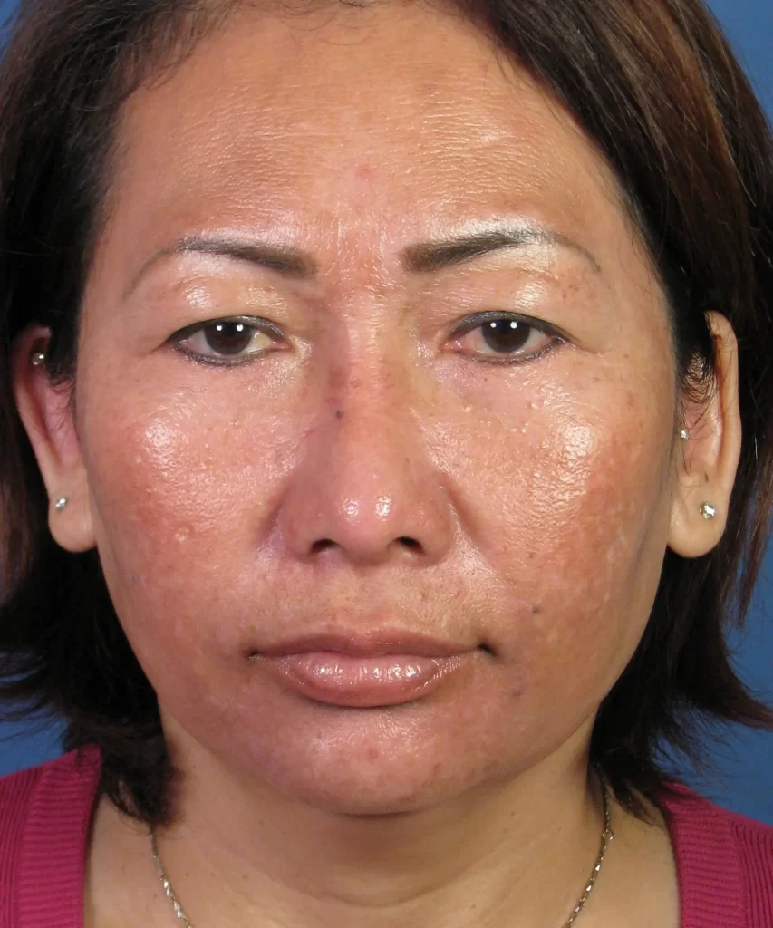 Front view of the face of a female Asian revision rhinoplasty patient after nose implant correction