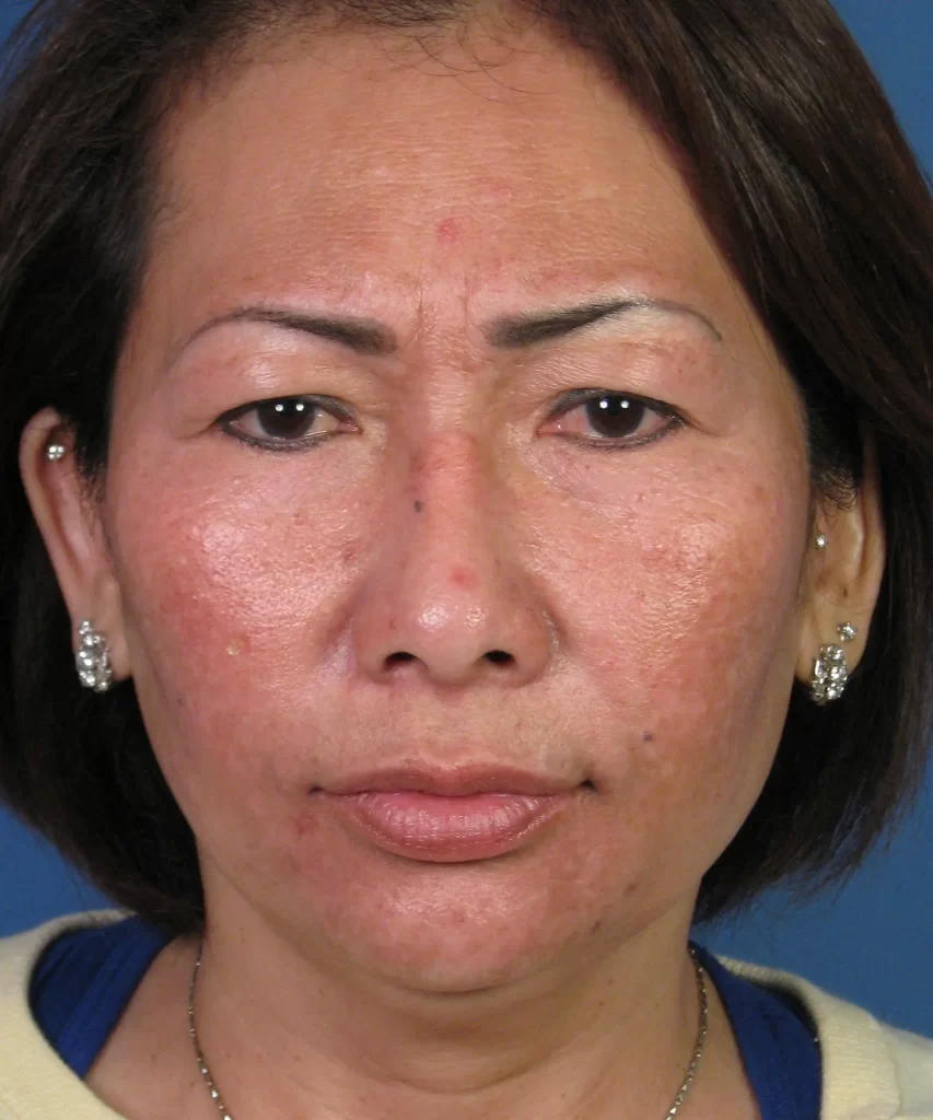 Front view of the face of a female Asian rhinoplasty revision patient