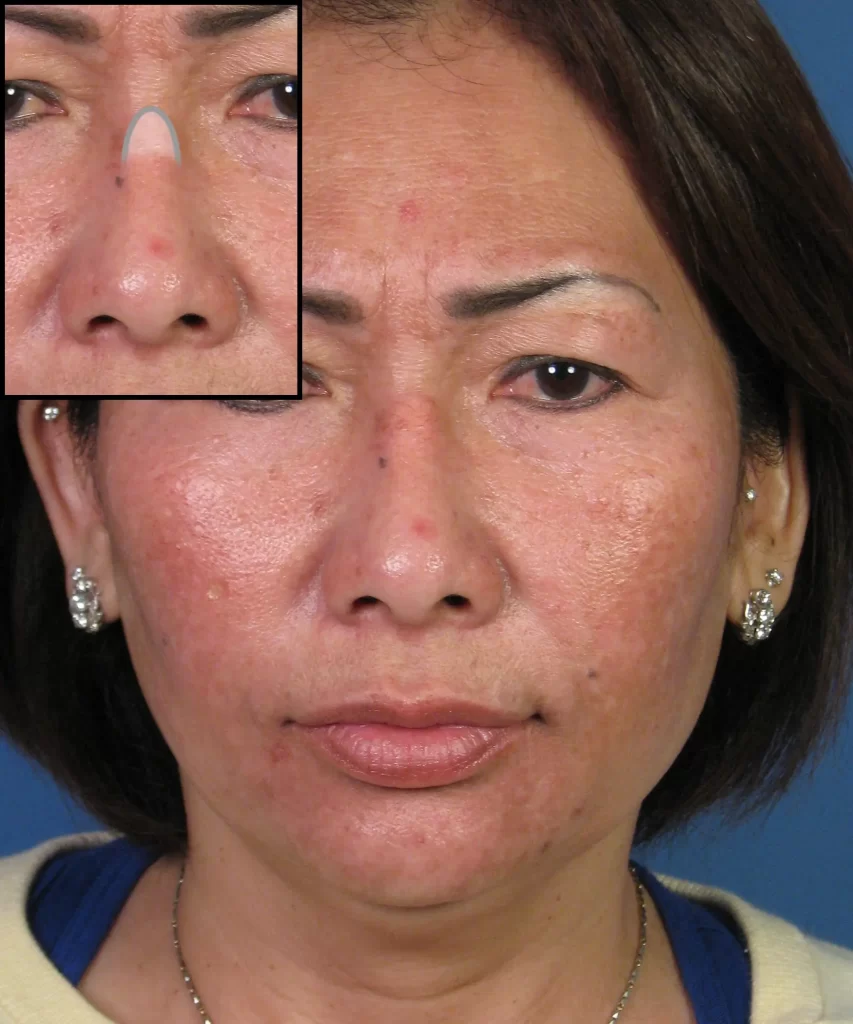 Front view of the face of a female Asian revision rhinoplasty patient with arrow pointing to the nasal bridge area where the previously placed implant moved.