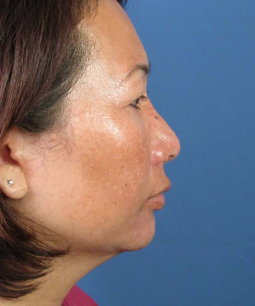 Lateral view of the face of a female Asian revision rhinoplasty patient before nose implant correction