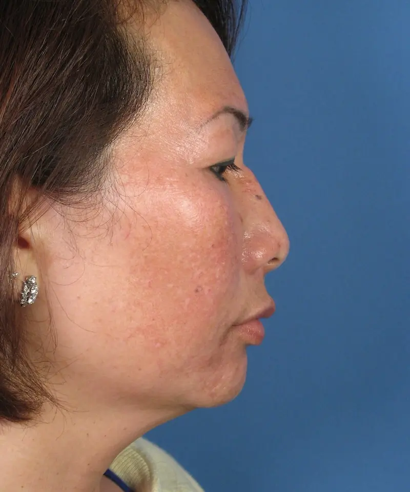 Lateral view of the face of a female Asian revision rhinoplasty patient before nose implant correction