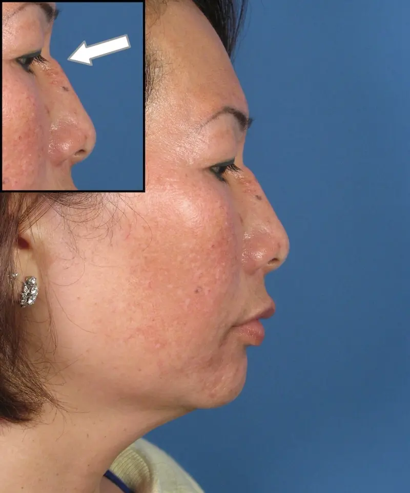 Side profile of a person showing a small raised bump near the eye, highlighted by an inset with an arrow pointing to it. The background is a solid blue.