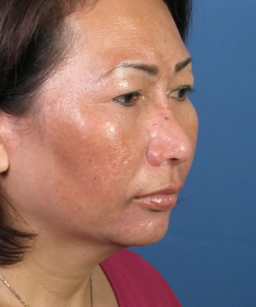 Oblique view of the face of a female Asian revision rhinoplasty patient before nose implant correction