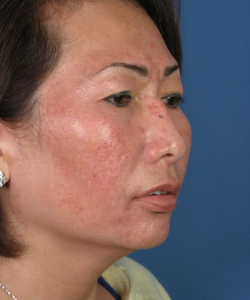 Oblique view of the face of a female Asian revision rhinoplasty patient before nose implant correction