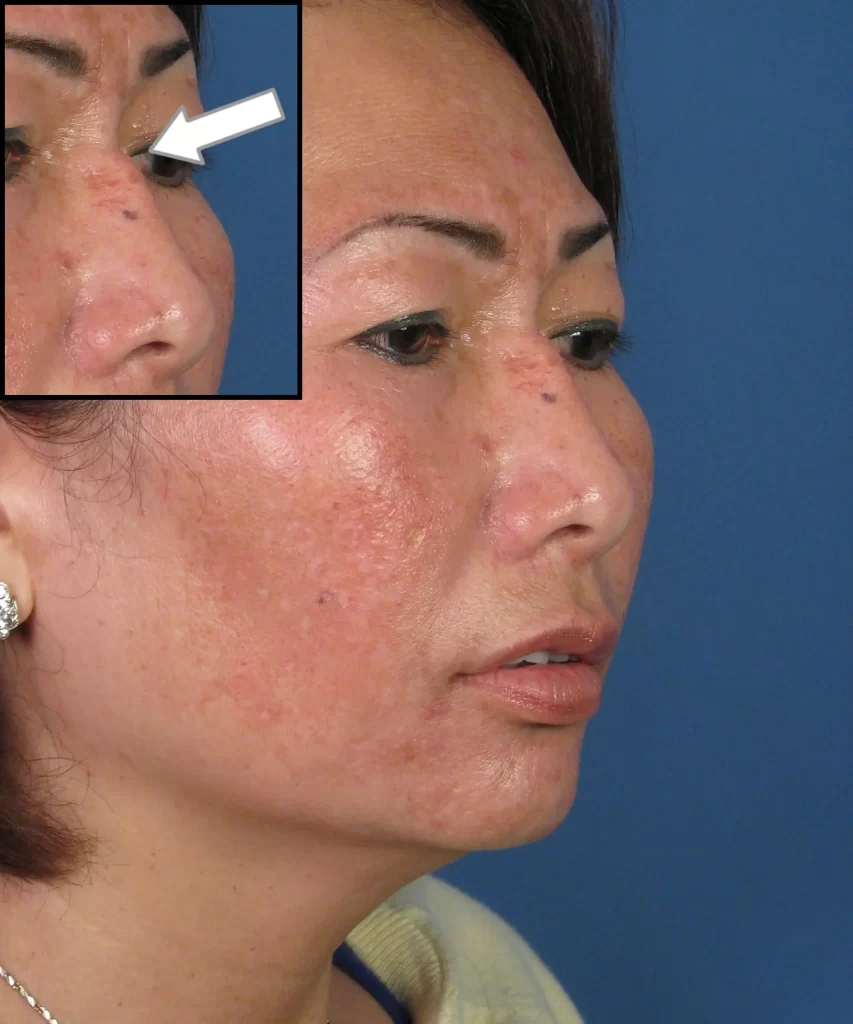 Close-up of a woman's face showing skin with acne scars and blemishes. An inset highlights a specific area on her nose with an arrow pointing to it.