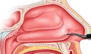 Medical illustration of a cross-section of the nasal cavity, showing detailed anatomy, with a tool pointing to a specific area.