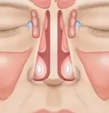 Medical illustration showing a front view of human sinuses. The image highlights sinus cavities in red and surrounding nasal structures, including the maxillary and ethmoid sinuses.