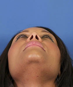 View of the female African-American patient's nose base after the African American rhinoplasty