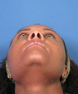 View of the female African-American patient's nose base before the African American rhinoplasty