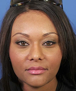 Front view of the face of female African-American patient after the African American rhinoplasty