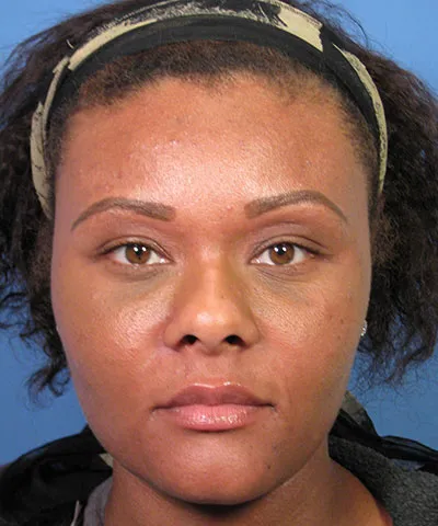 Front view of the face of female African-American patient before the African American rhinoplasty