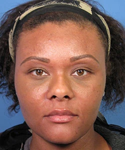 Front view of the face of female African-American patient before the African American rhinoplasty