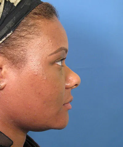 Profile view of the face of a female African-American patient after the African American rhinoplasty