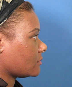 Lateral view of the face of a female African-American patient before the African American rhinoplasty