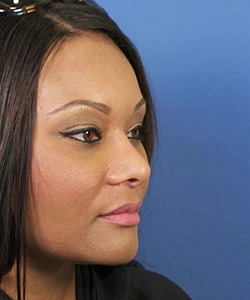 Oblique view of the face of a female African-American patient after the African American rhinoplasty