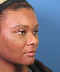 Oblique view of the face of a female African-American patient before the African American rhinoplasty