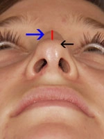 Close-up of a person's nose with colored arrows indicating three areas: blue arrow on the bridge, red arrow on the septum, and black arrow on the nostril side.