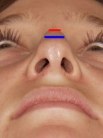 Close-up view of a person's nose from below, with colored lines drawn on the bridge.