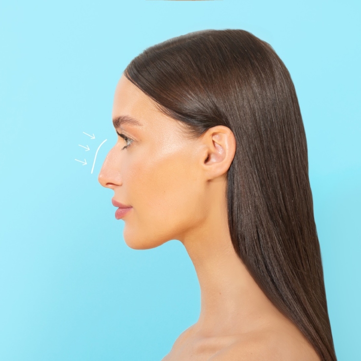 Profile of a woman with long brown hair against a blue background, showing arrows pointing to her nose.